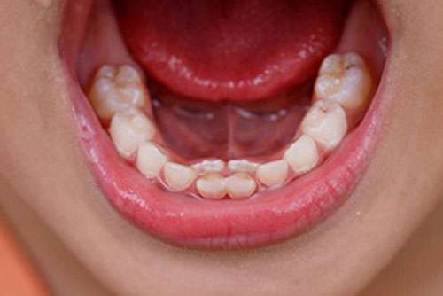 Up close shot of frenectomy