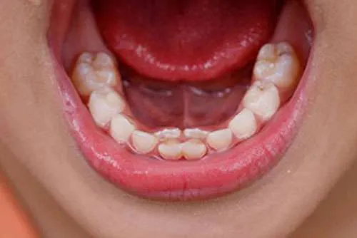 Up close shot of frenectomy
